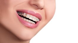Ваш путь к идеальной улыбке! Скидка 50% на американские брекеты American Orthodontic от Сети медицинских клиник «Здравия»